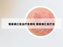 银屑病三氧治疗有用吗 银屑病三氧疗法