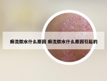 癣流脓水什么原因 癣流脓水什么原因引起的