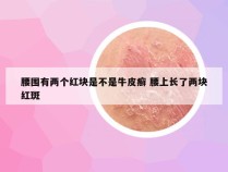 腰围有两个红块是不是牛皮癣 腰上长了两块红斑