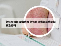 急性点状银屑病病因 急性点滴状银屑病能彻底治愈吗