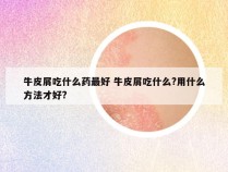 牛皮屑吃什么药最好 牛皮屑吃什么?用什么方法才好?