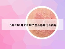 上身长癣 身上长癣了怎么办用什么药好