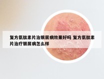 复方氨肽素片治银屑病效果好吗 复方氨肽素片治疗银屑病怎么样