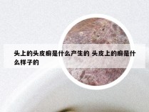 头上的头皮癣是什么产生的 头皮上的癣是什么样子的