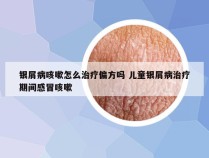 银屑病咳嗽怎么治疗偏方吗 儿童银屑病治疗期间感冒咳嗽