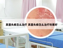 真菌头癣怎么治疗 真菌头癣怎么治疗效果好