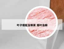 叶子烟能治银屑 烟叶治癣