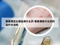 银屑病怎么根治用什么药 银屑病有什么好的治疗方法吗