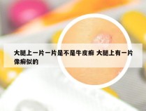 大腿上一片一片是不是牛皮癣 大腿上有一片像癣似的