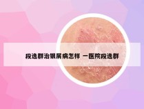 段逸群治银屑病怎样 一医院段逸群