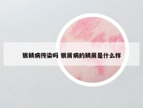 银鳞病传染吗 银屑病的鳞屑是什么样