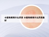 小腿有癣用什么药膏 小腿有癣用什么药膏最好