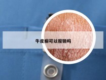 牛皮癣可以报销吗