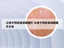 让蚊子咬后变成癣图片 让蚊子咬后变成癣图片大全