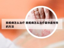 脓疱病怎么治疗 脓疱病怎么治疗最快最有效的方法