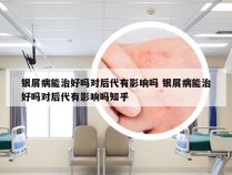 银屑病能治好吗对后代有影响吗 银屑病能治好吗对后代有影响吗知乎