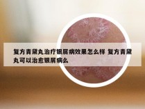 复方青黛丸治疗银屑病效果怎么样 复方青黛丸可以治愈银屑病么