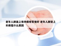 老年人脚面上有块癣非常难好 老年人脚背上长癣是什么原因