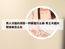 男人大腿内测张一种癣是什么癣 男士大腿内侧有癣怎么办