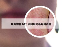 腿癣擦什么好 治腿癣的最好的药膏