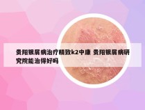 贵阳银屑病治疗精致k2中康 贵阳银屑病研究院能治得好吗