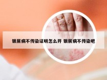 银屑病不传染证明怎么开 银屑病不传染吧