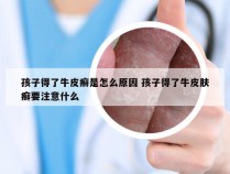 孩子得了牛皮癣是怎么原因 孩子得了牛皮肤癣要注意什么