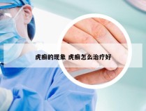 虎癣的现象 虎癣怎么治疗好