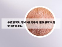 牛皮癣可以用999皮炎平吗 银屑病可以用999皮炎平吗