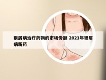 银屑病治疗药物的市场份额 2021年银屑病新药