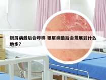 银屑病最后会咋样 银屑病最后会发展到什么地步?