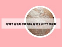 吃蝎子能治疗牛皮癣吗 吃蝎子治好了银屑病