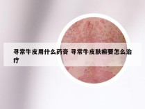 寻常牛皮用什么药膏 寻常牛皮肤癣要怎么治疗