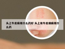 头上牛皮癣用什么药好 头上有牛皮病癣用什么药