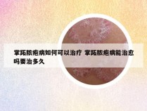 掌跖脓疱病如何可以治疗 掌跖脓疱病能治愈吗要治多久