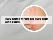 点滴型银屑病治愈了能喝酒吗 点滴型银屑病治愈后会留疤吗