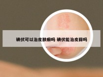 碘伏可以治皮肤癣吗 碘伏能治皮藓吗