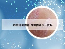 白斑给会传开 白斑传染下一代吗