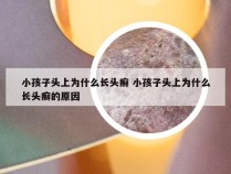 小孩子头上为什么长头癣 小孩子头上为什么长头癣的原因