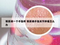 银屑病一个手指疼 银屑病手指关节肿痛怎么办