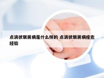 点滴状银屑病是什么样的 点滴状银屑病痊愈经验