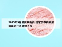 2023年9月银屑病新药 国家公布的银屑病新药什么时候上市