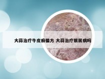 大蒜治疗牛皮癣偏方 大蒜治疗银屑病吗