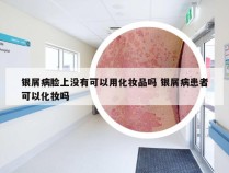 银屑病脸上没有可以用化妆品吗 银屑病患者可以化妆吗