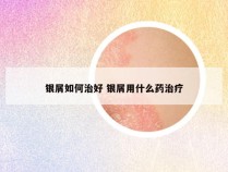 银屑如何治好 银屑用什么药治疗