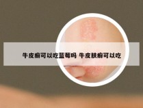 牛皮癣可以吃蓝莓吗 牛皮肤癣可以吃