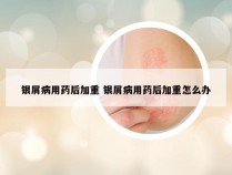 银屑病用药后加重 银屑病用药后加重怎么办