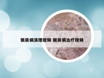 银屑病清理视频 银屑病治疗视频