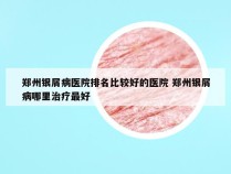 郑州银屑病医院排名比较好的医院 郑州银屑病哪里治疗最好