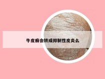 牛皮癣会转成抑制性皮炎么